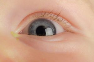 what to do when your child has pink eye 
